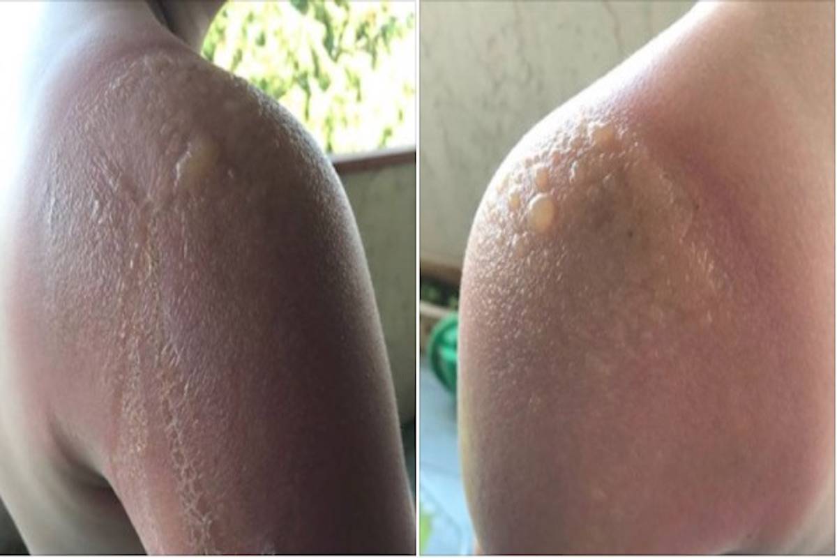 A Victoria mother says her son suffered serious blistering after applying a Banana Boat sunscreen spray during a class trip to the beach. (Facebook/Patrizia Fitch)